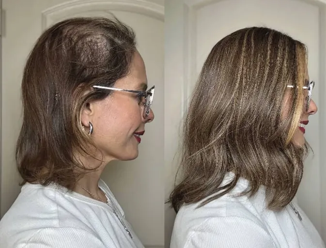 How Hair Toppers Can Change Life